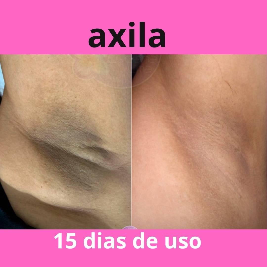 Antes e Depois Axilas e Virilha