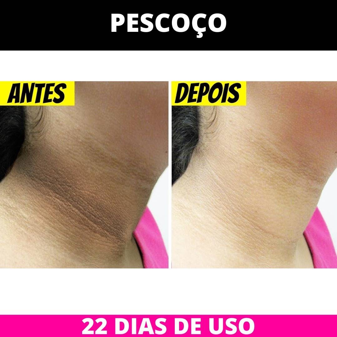 Antes e Depois Pescoço