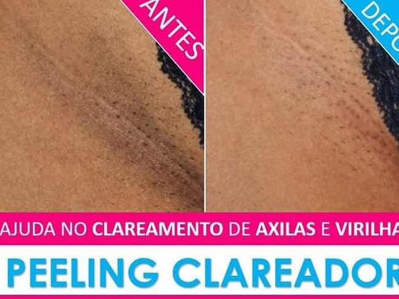 Clareamento de Virilha